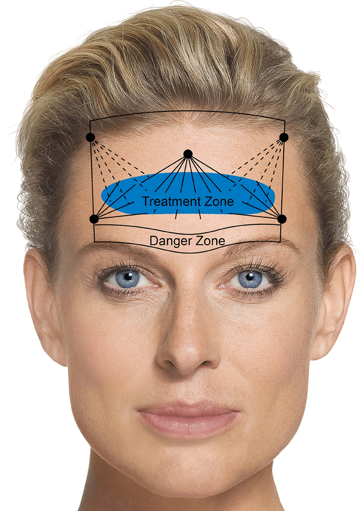 Botox Forehead Danger Zones
