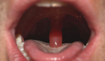 Can a swollen uvula be fatal