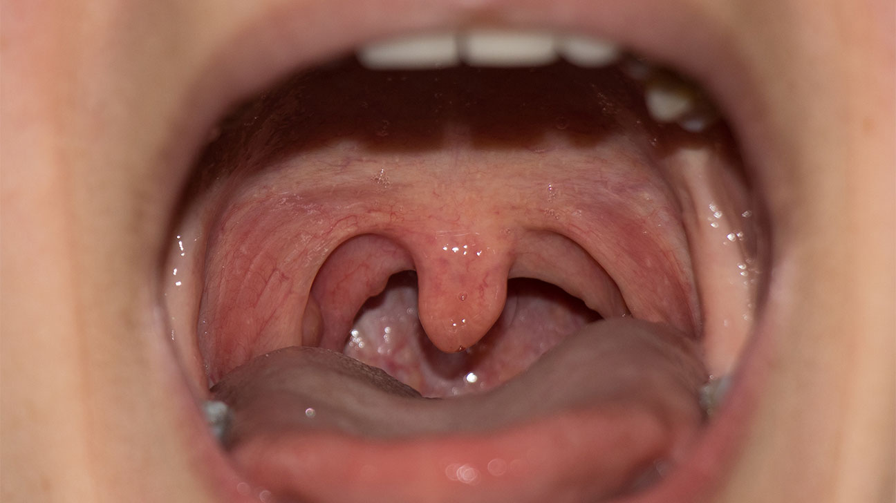 Can A Swollen Uvula Be Fatal