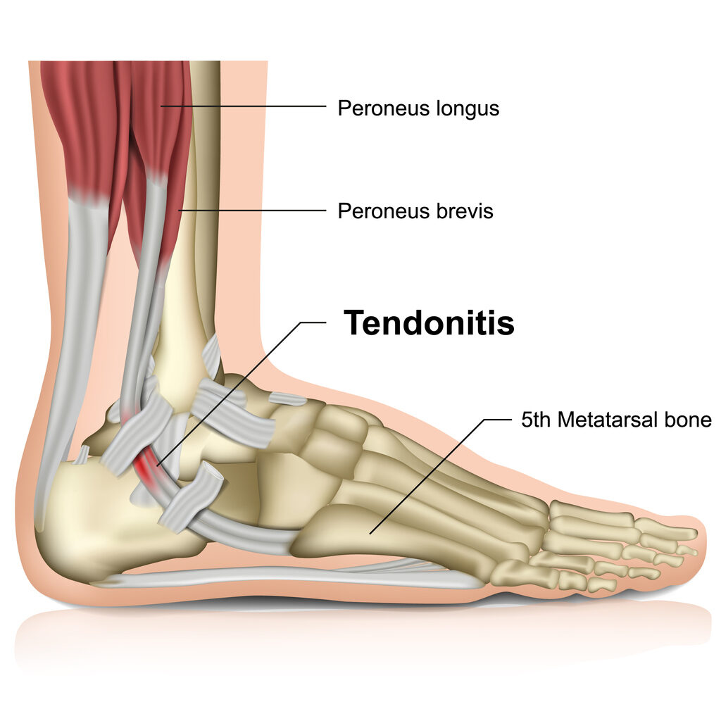 Can you walk on a torn tendon in foot?