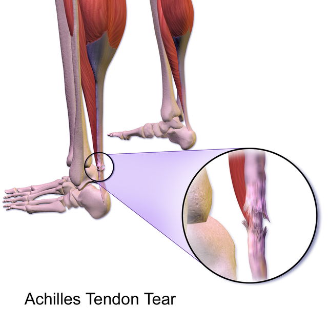 How long does torn tendon take to heal