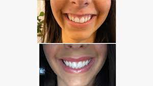 Does lip flip affect speech
