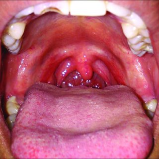 Does the uvula deviate to the side of the lesion