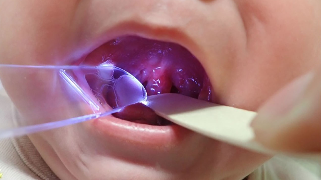 Is it good to remove uvula?