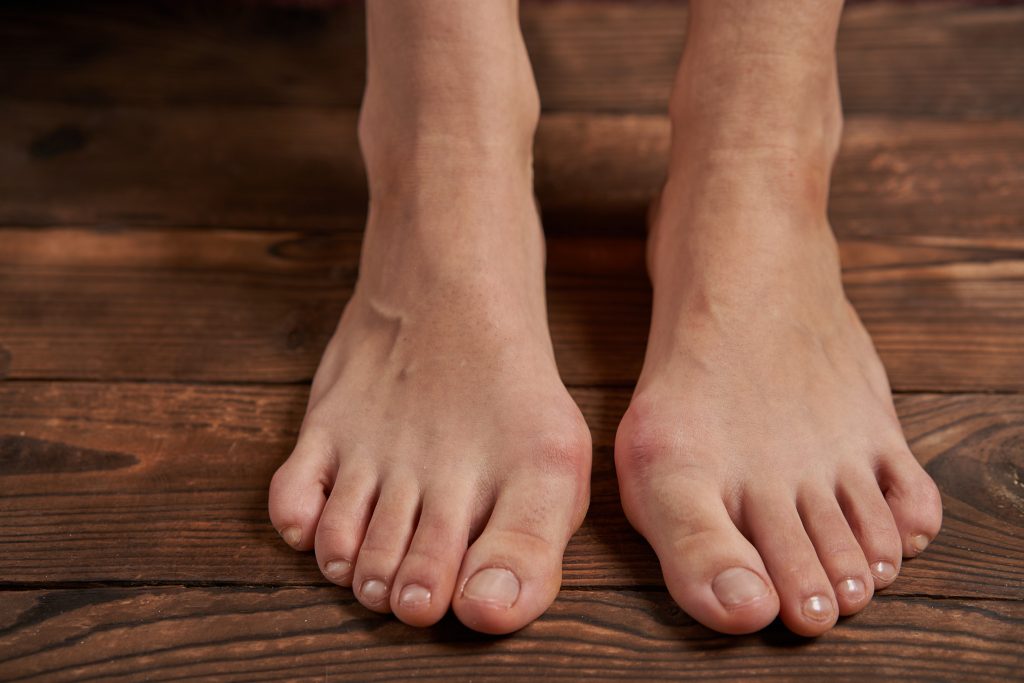 How long does it take to recover from Lapiplasty bunion surgery