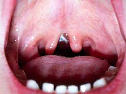How rare is a double uvula