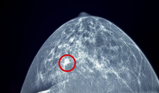 icd-10 code for diagnostic mammogram with ultrasound