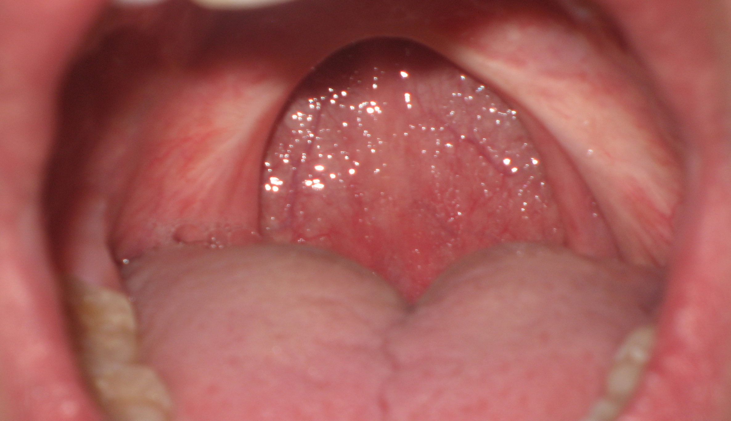 Is it good to remove uvula