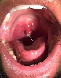 What does it mean when the tip of your uvula is white