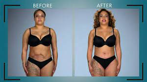 Botched liposuction before and after