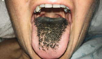Pepto Bismol Black Tongue