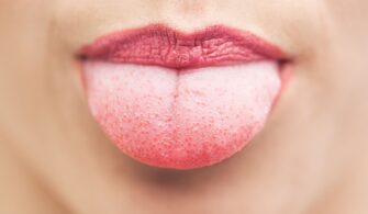 Swollen Taste Buds on Tongue