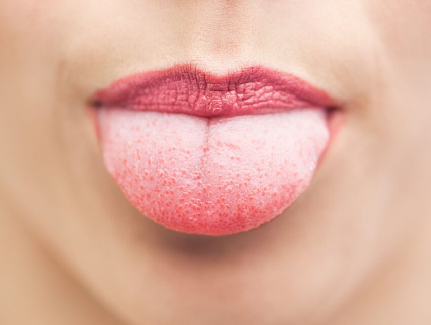 Swollen Taste Buds on Tongue