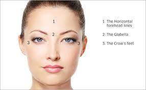What are the 3 areas for Botox
