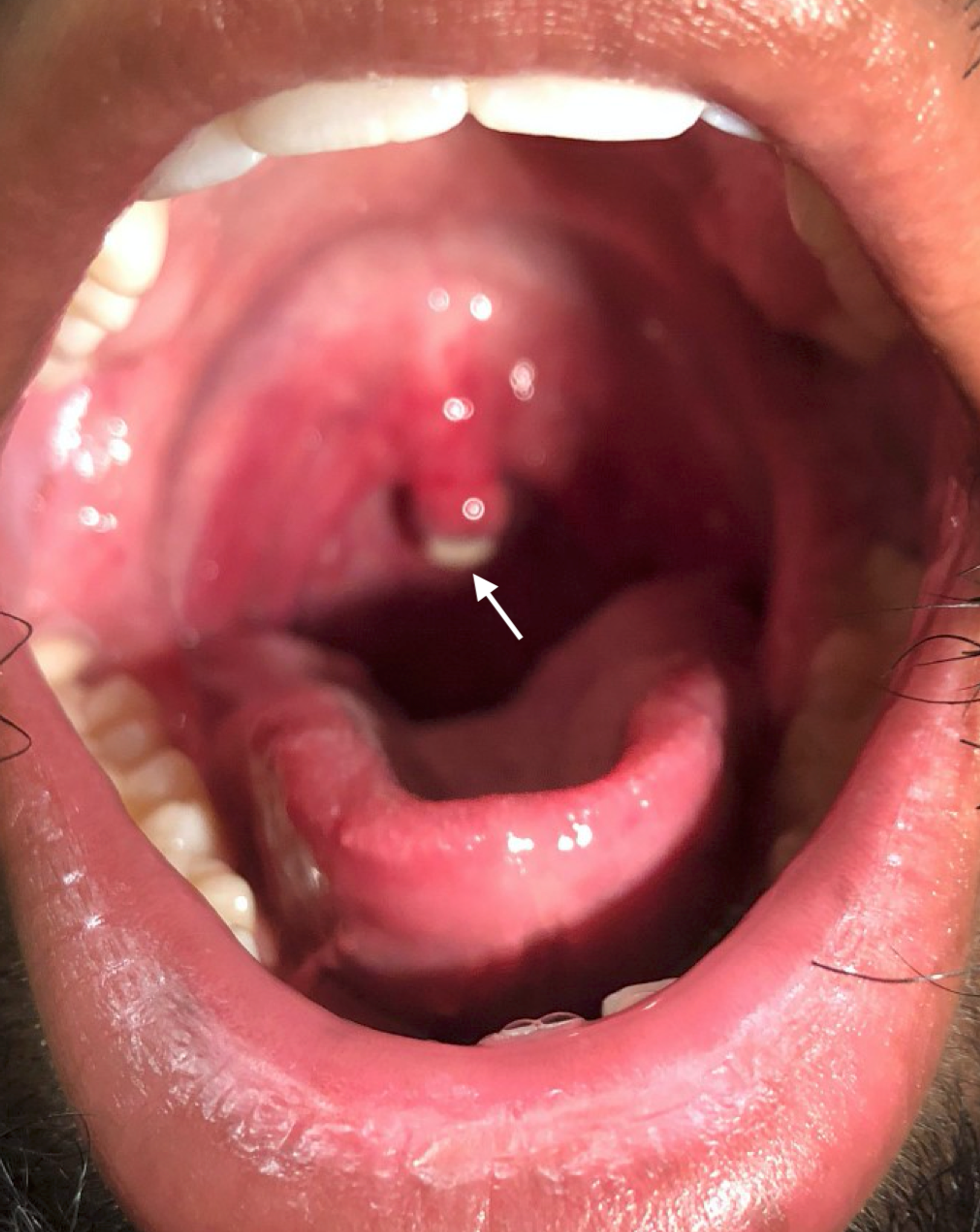 What causes canker sores on your uvula