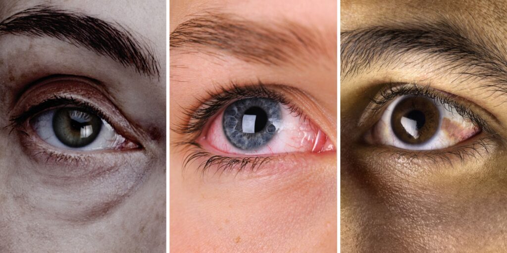 What does the white of your eyes say about your health?