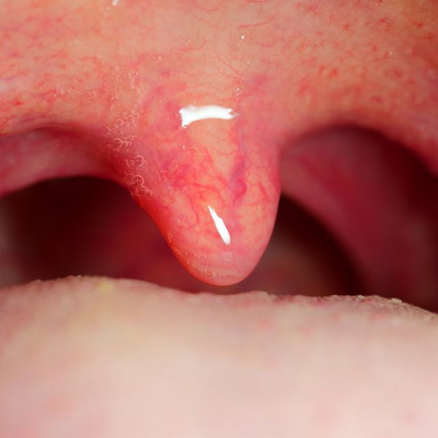 What happens if uvula is damaged