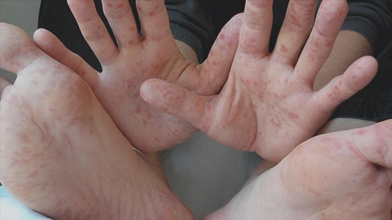 What helps with itching from hand foot and mouth?