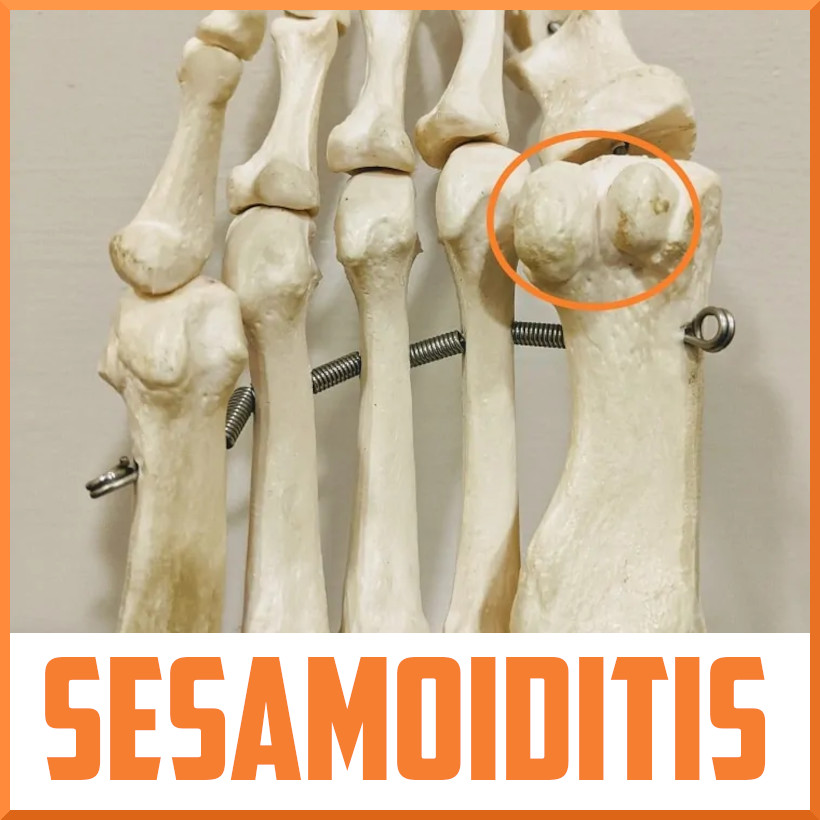 What is the sesamoid bone in the foot