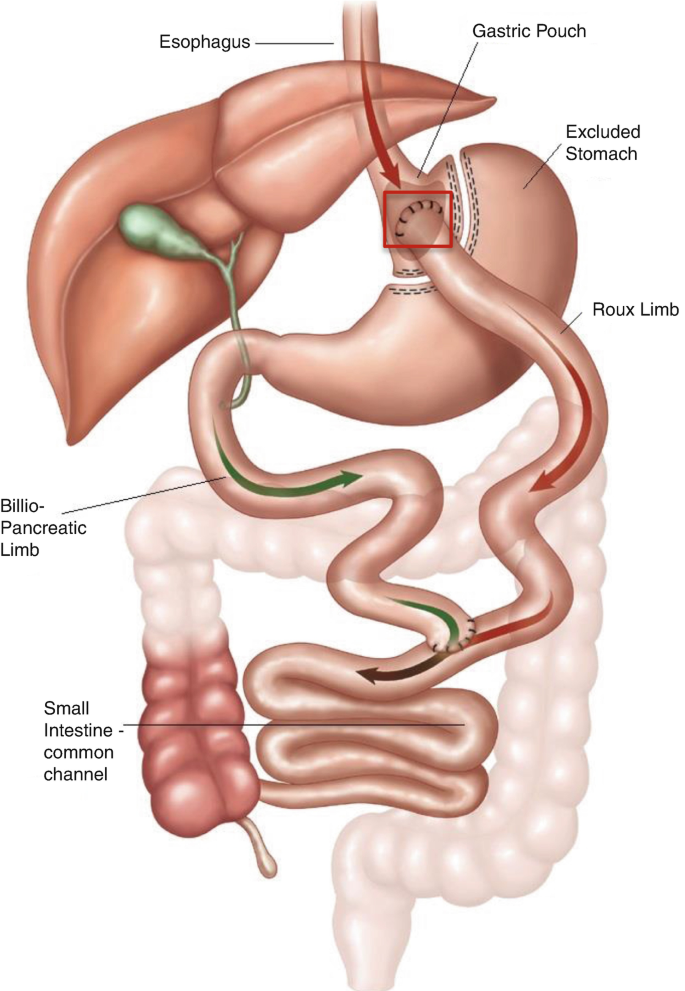Is a marginal ulcer a complication of gastric bypass
