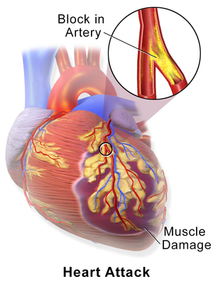 What are 3 symptoms of a myocardial infarction