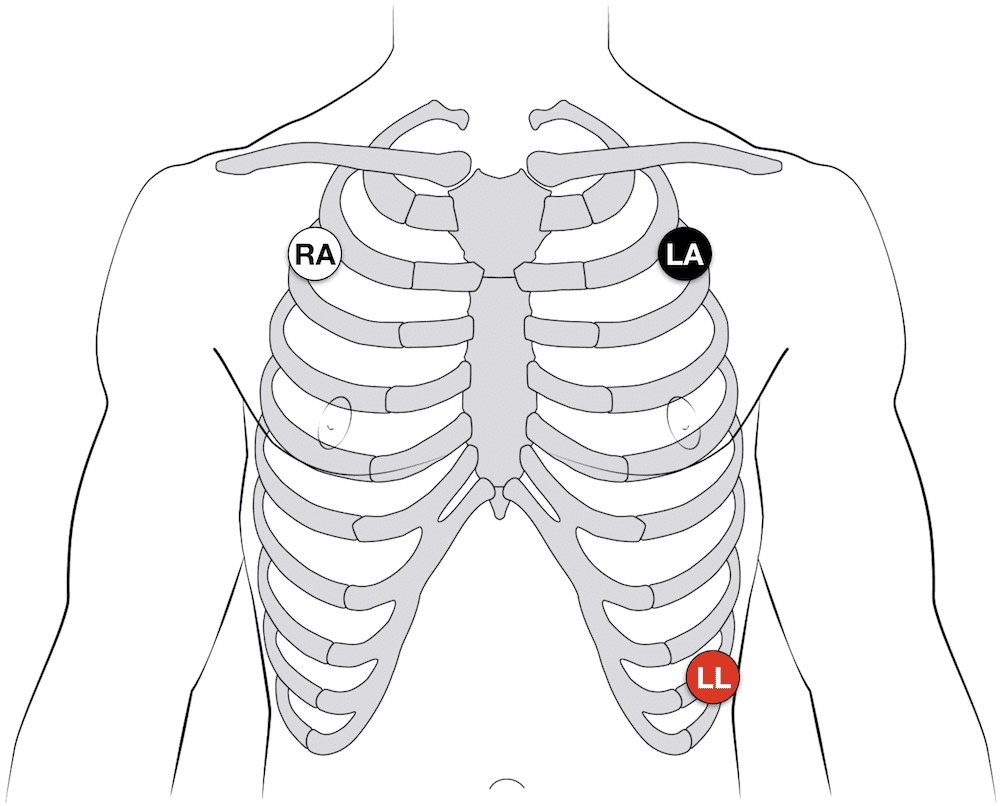 How do you place 3 electrodes on an ECG