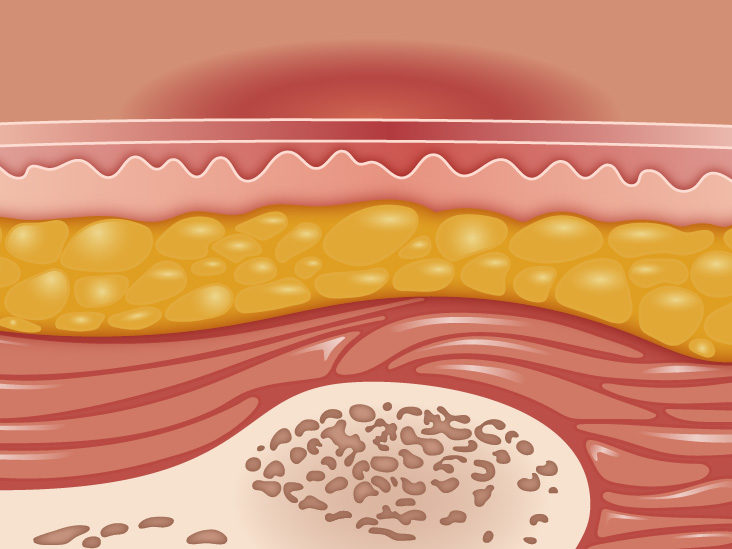 What are the 4 types of ulcers