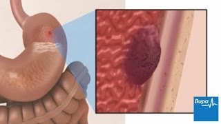 What are the worst symptoms of ulcer