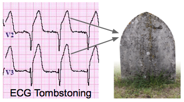 What does a tombstone ECG look like