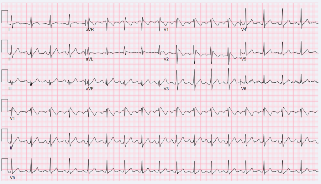 What is abnormal ECG