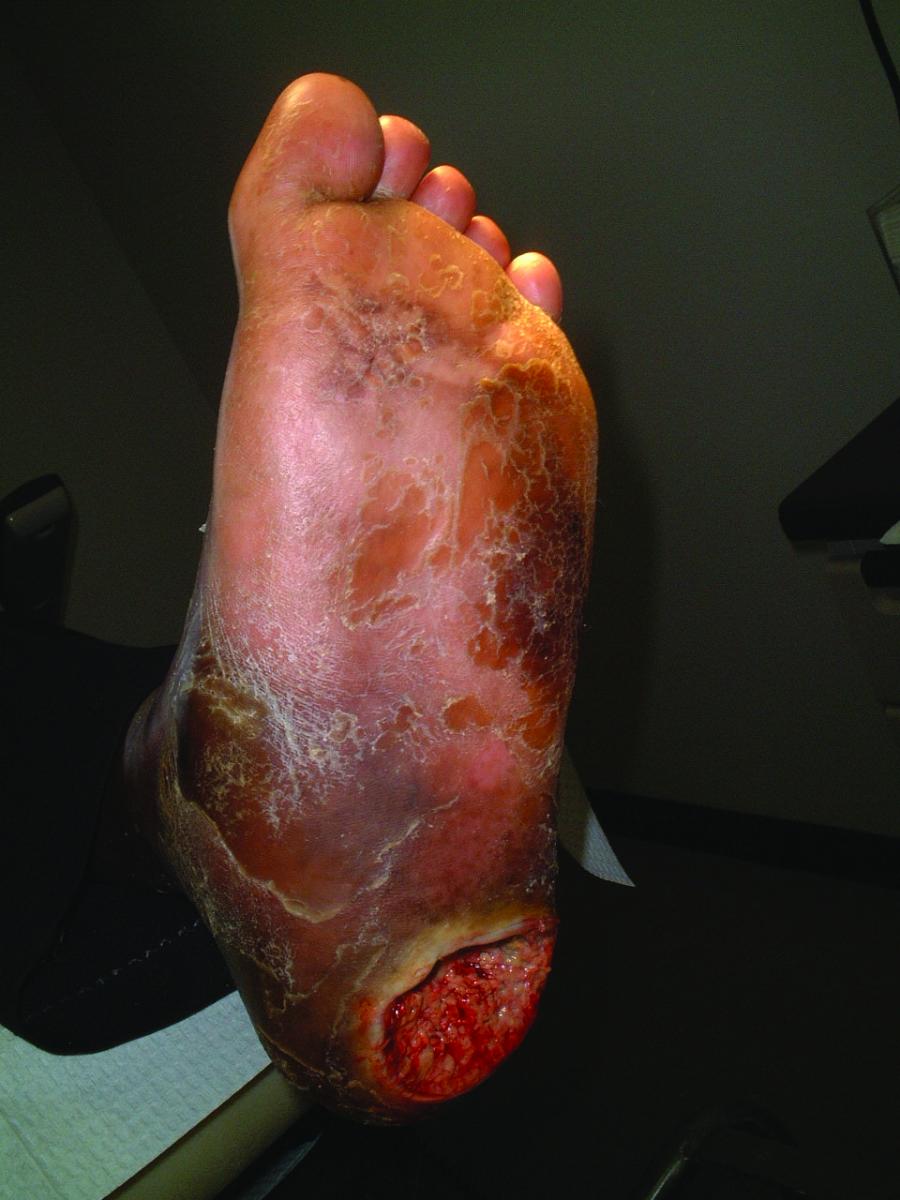 What is the ICD-10 code for diabetic foot ulcer