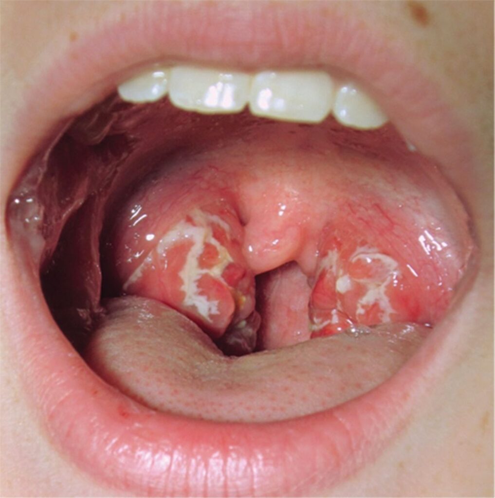 What is tonsillar carcinoma