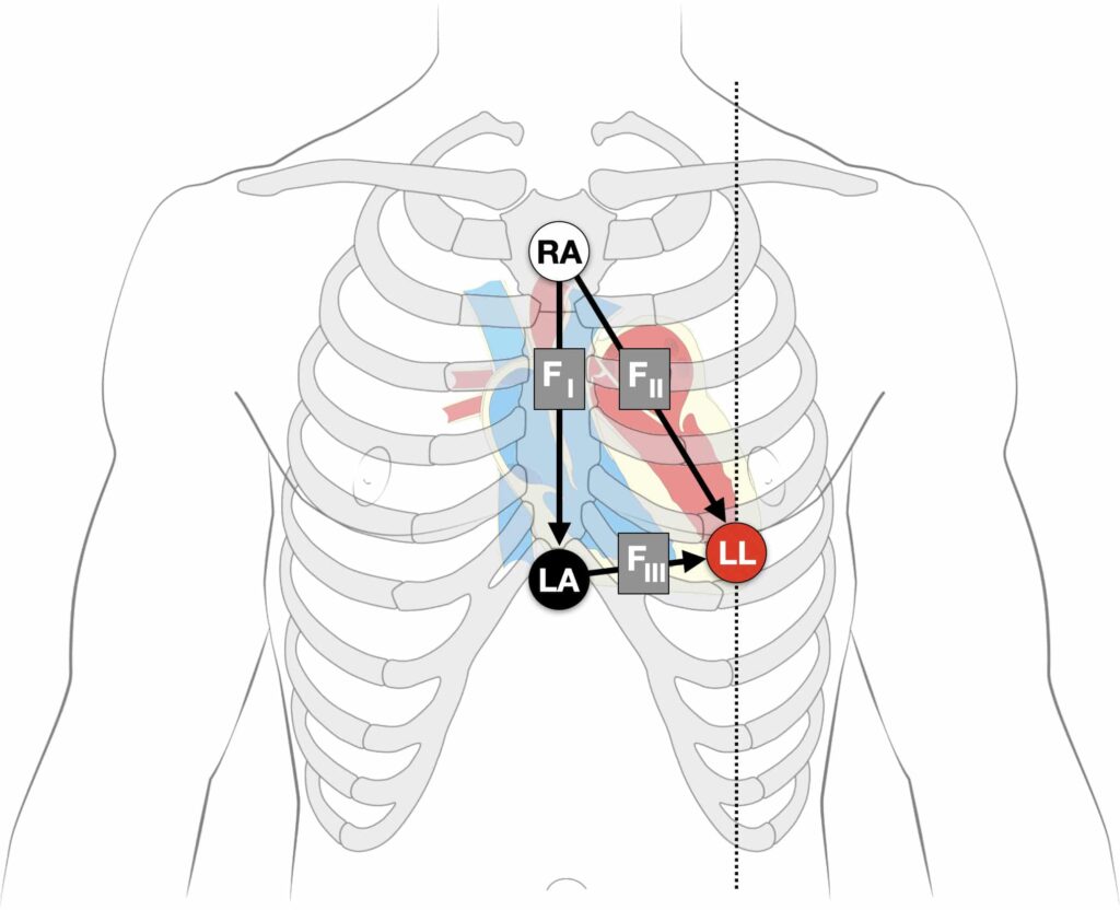 Where do the leads go on a 3 lead ECG