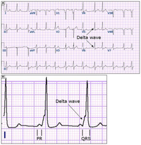 delta wave ecg