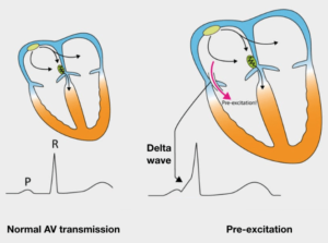 delta wave ecg