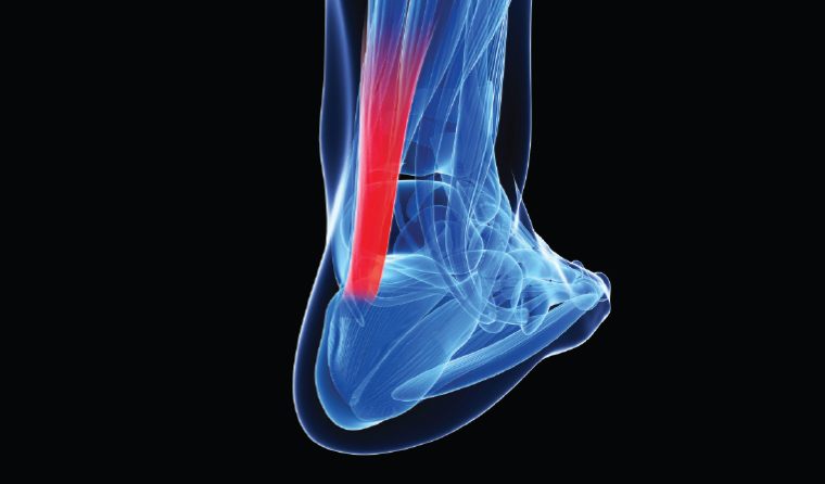 What are the long term effects of Achilles rupture
