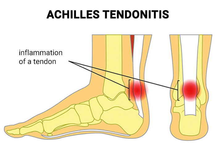 Is Achilles tendon surgery painful