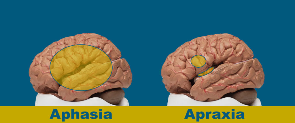What can be mistaken for aphasia