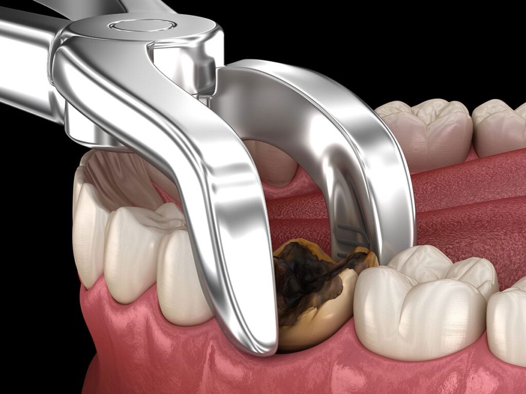 Does insurance cover anesthesia for tooth extraction