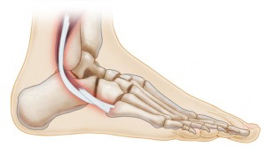 How do you know if you need peroneal tendon surgery
