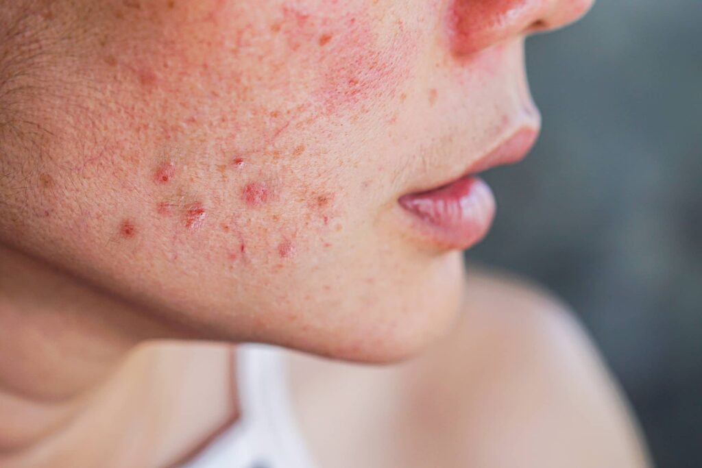 How do you get rid of menopausal acne