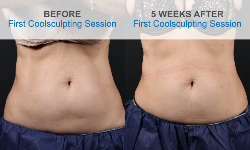 Non Surgical Tummy Tuck