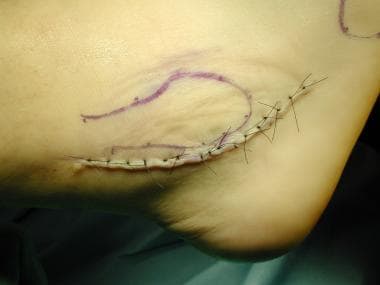 Peroneal tendon surgery