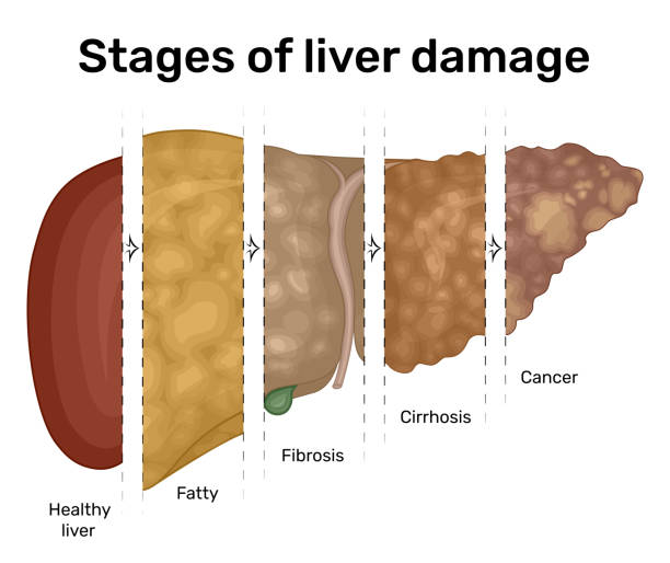 What is the most common cause of death in patients with cirrhosis