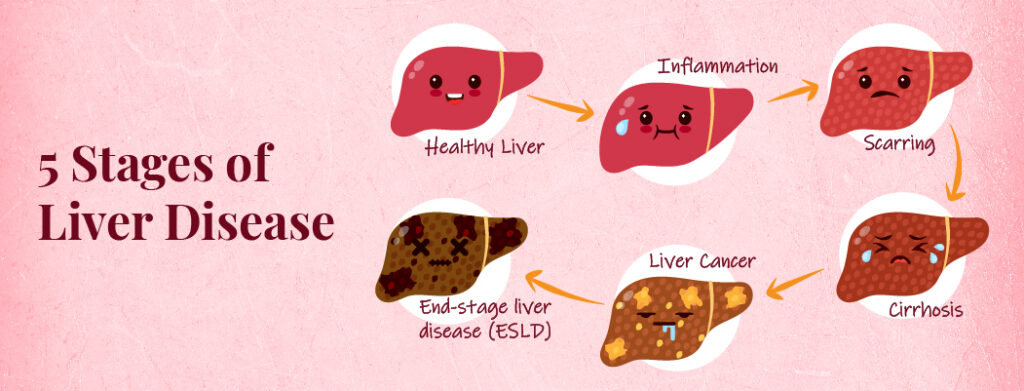How long does final stage of cirrhosis last