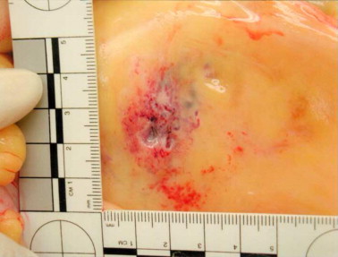Sudden Death From Cirrhosis of The Liver