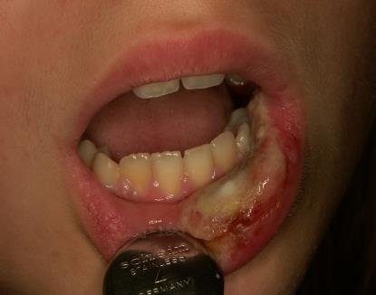 What happens if you bite your lip after anesthesia