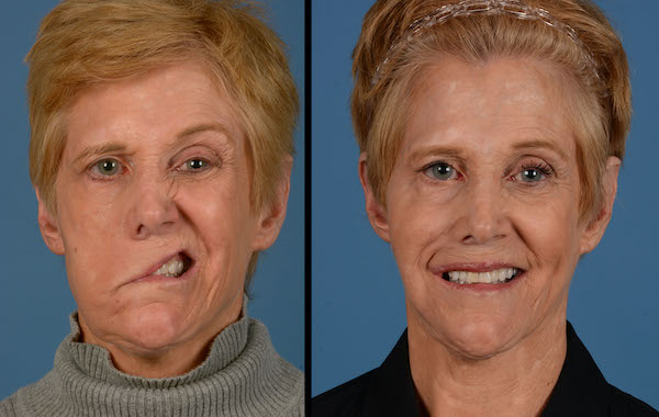 Can Botox help facial paralysis
