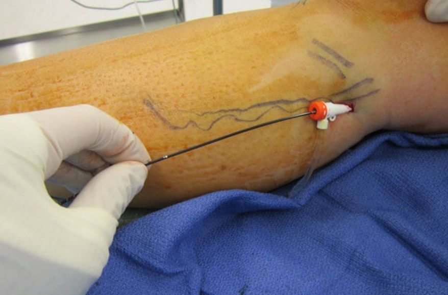 Deep Vein Thrombosis Laser Treatment
