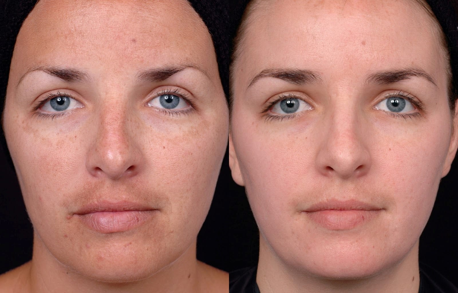 Do Chemical Peels Remove Freckles